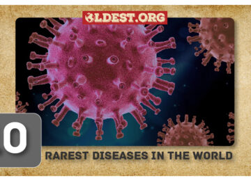 Rarest Diseases In The World